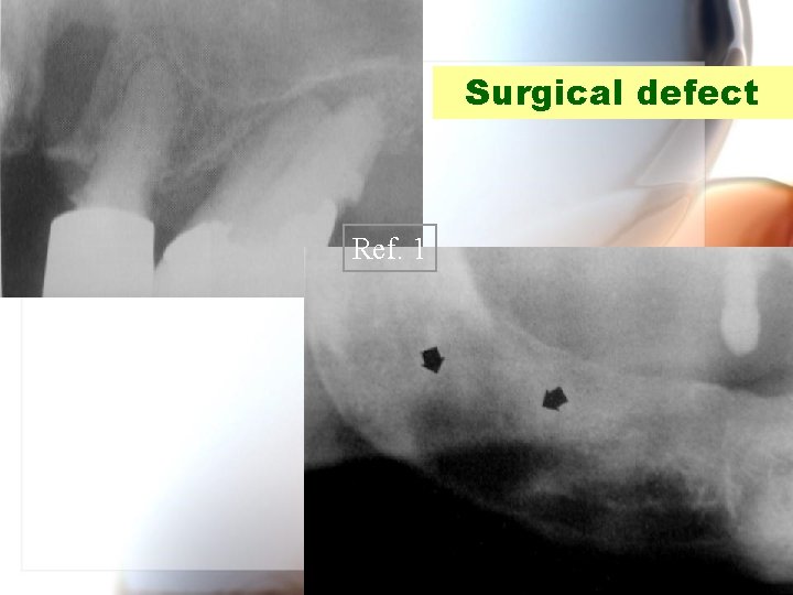 Surgical defect Ref. 1 Wen. Chen Wang 