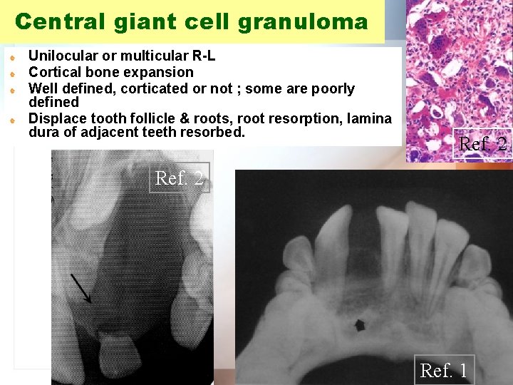 Central giant cell granuloma | | Unilocular or multicular R-L Cortical bone expansion Well