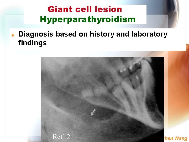 Giant cell lesion Hyperparathyroidism | Diagnosis based on history and laboratory findings Ref. 2