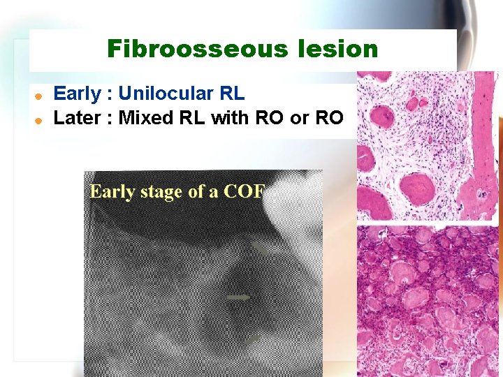 Fibroosseous lesion | | Early : Unilocular RL Later : Mixed RL with RO