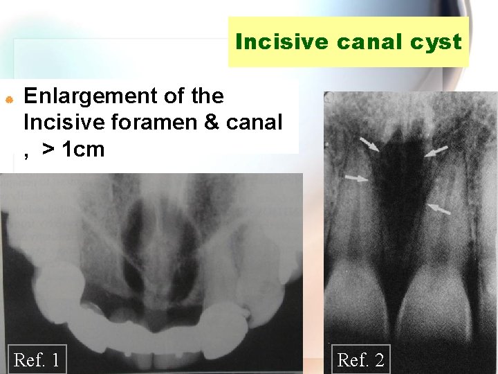 Incisive canal cyst | Enlargement of the Incisive foramen & canal , > 1