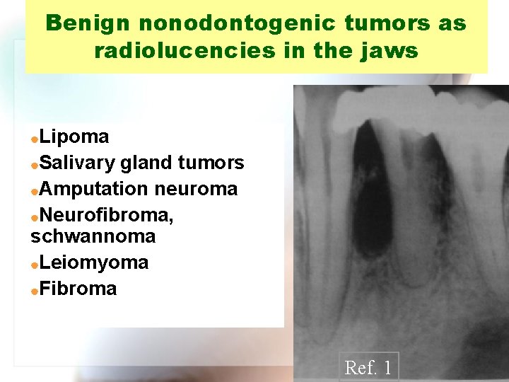 Benign nonodontogenic tumors as radiolucencies in the jaws Lipoma |Salivary gland tumors |Amputation neuroma