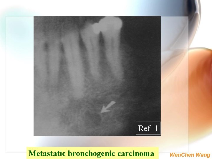 Ref. 1 Metastatic bronchogenic carcinoma Wen. Chen Wang 