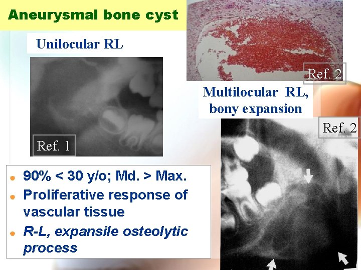 Aneurysmal bone cyst Unilocular RL Ref. 2 Multilocular RL, bony expansion Ref. 2 Ref.