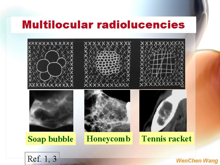 Multilocular radiolucencies Soap bubble Ref. 1, 3 Honeycomb Tennis racket Wen. Chen Wang 