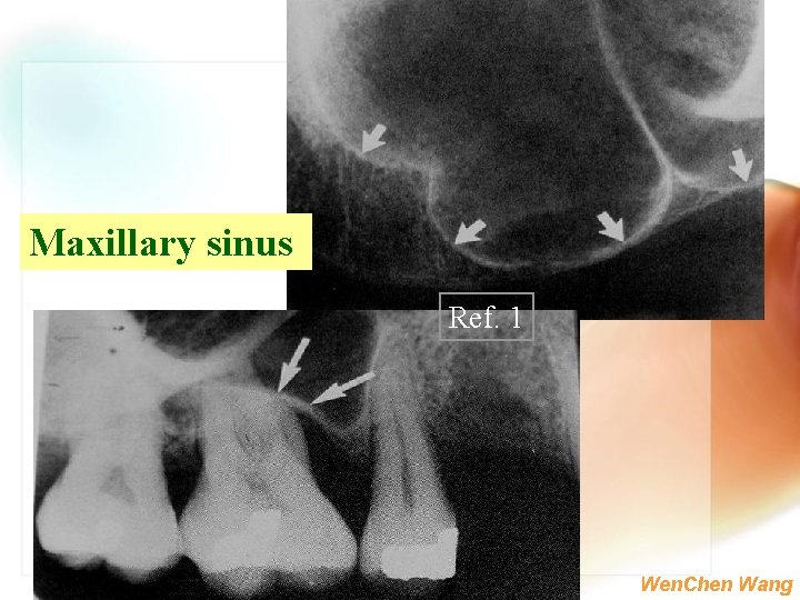 Maxillary sinus Ref. 1 Wen. Chen Wang 