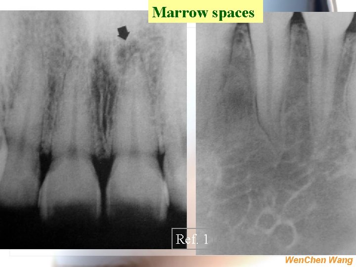 Marrow spaces Ref. 1 Wen. Chen Wang 