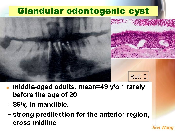 Glandular odontogenic cyst Ref. 2 | middle-aged adults, mean=49 y/o；rarely before the age of