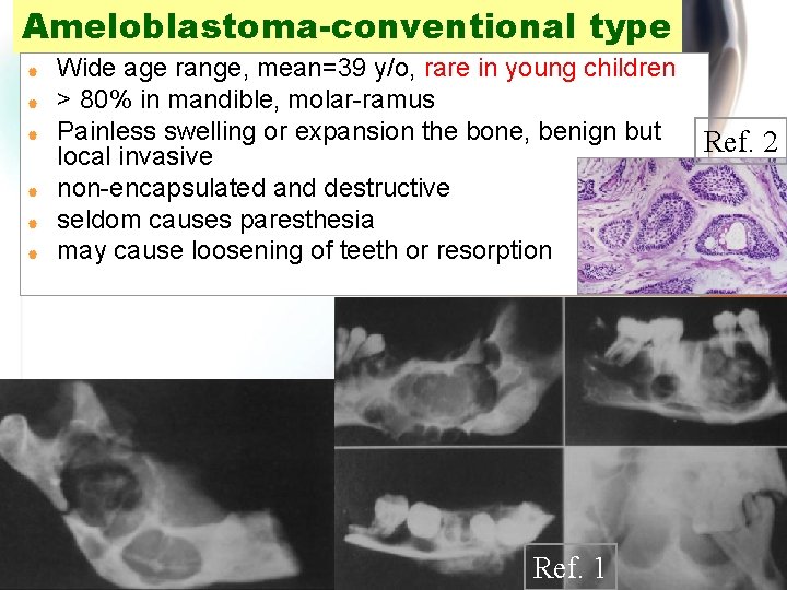 Ameloblastoma-conventional type | | | Wide age range, mean=39 y/o, rare in young children