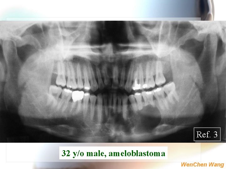 Ref. 3 32 y/o male, ameloblastoma Wen. Chen Wang 