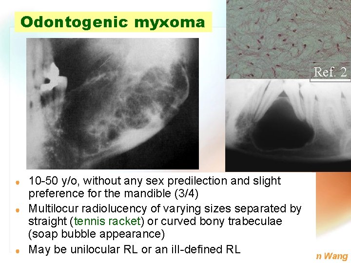 Odontogenic myxoma Ref. 2 | | | 10 -50 y/o, without any sex predilection