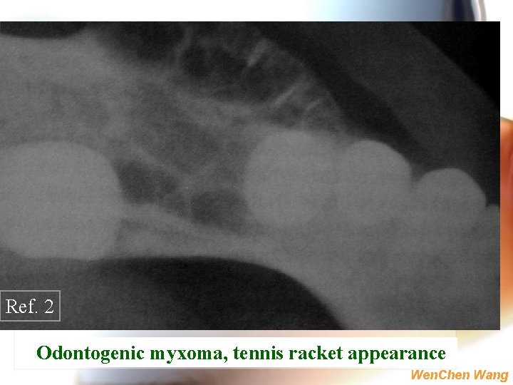 Ref. 2 Odontogenic myxoma, tennis racket appearance Wen. Chen Wang 