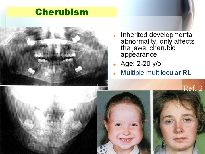 Cherubism | | | Inherited developmental abnormality, only affects the jaws, cherubic appearance Age: