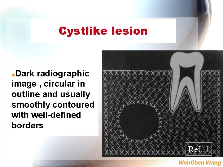 Cystlike lesion Dark radiographic image , circular in outline and usually smoothly contoured with