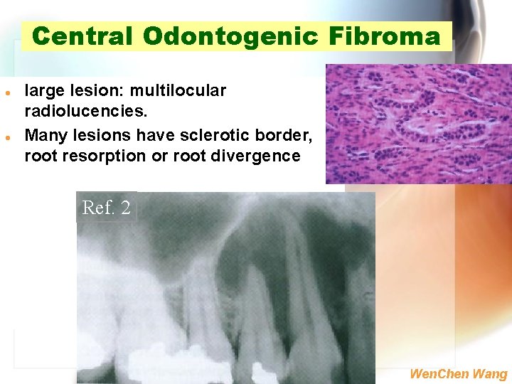 Central Odontogenic Fibroma l l large lesion: multilocular radiolucencies. Many lesions have sclerotic border,