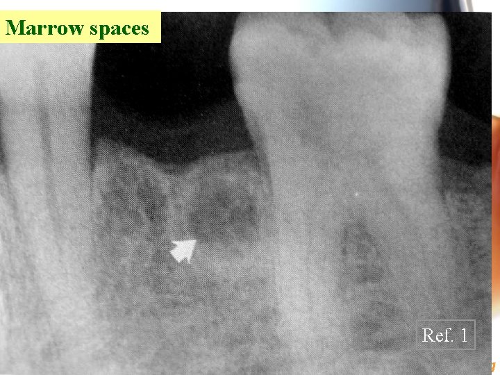 Marrow spaces Ref. 1 Wen. Chen Wang 