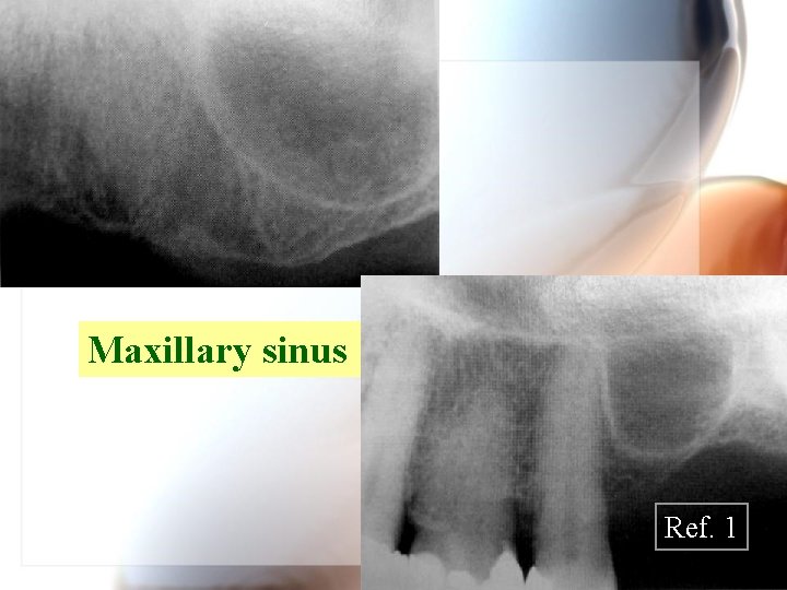 Maxillary sinus Ref. 1 Wen. Chen Wang 