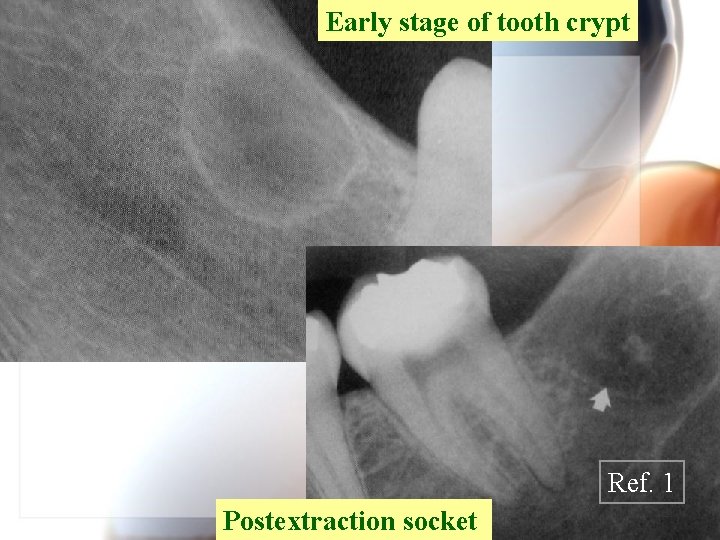 Early stage of tooth crypt Ref. 1 Postextraction socket Wen. Chen Wang 