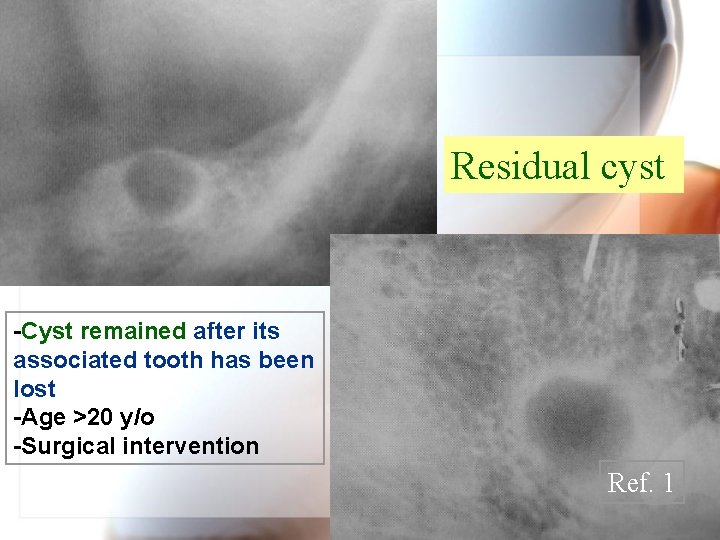 Residual cyst -Cyst remained after its associated tooth has been lost -Age >20 y/o