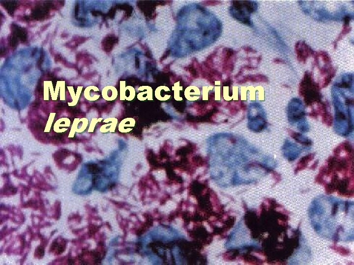 Mycobacterium leprae Mycobacterium leprae