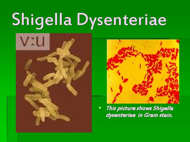Shigella Dysenteriae § This picture shows Shigella dysenteriae in Gram stain. Shigella Dysenteriae § This picture shows Shigella dysenteriae in Gram stain.