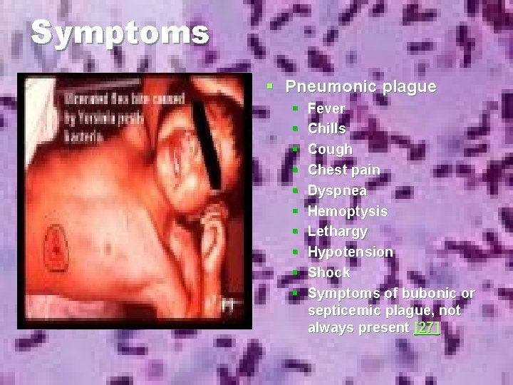 Symptoms § Pneumonic plague § § § § § Fever Chills Cough Chest pain Symptoms § Pneumonic plague § § § § § Fever Chills Cough Chest pain