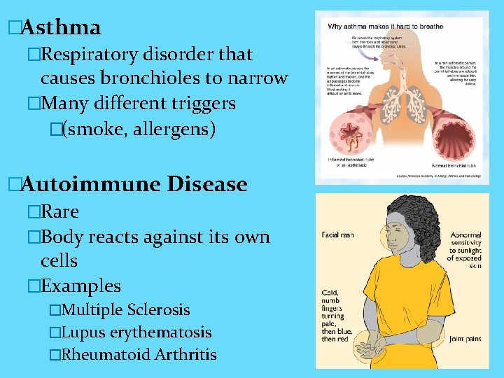 �Asthma �Respiratory disorder that causes bronchioles to narrow �Many different triggers �(smoke, allergens) �Autoimmune