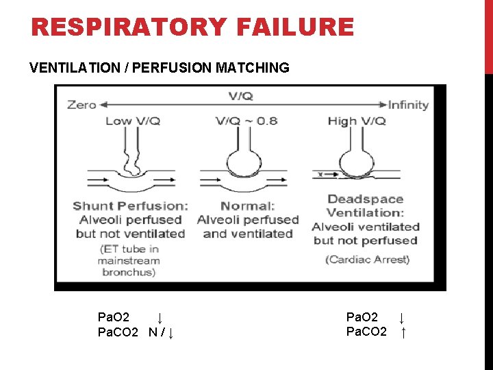 RESPIRATORY FAILURE VENTILATION / PERFUSION MATCHING Pa. O 2 ↓ Pa. CO 2 N
