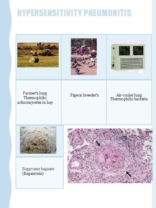 HYPERSENSITIVITY PNEUMONITIS Farmer’s lung Thermophilic actinomycetes in hay Sugarcane bagasse (Bagassosis) Pigeon breeder’s Air-cooler