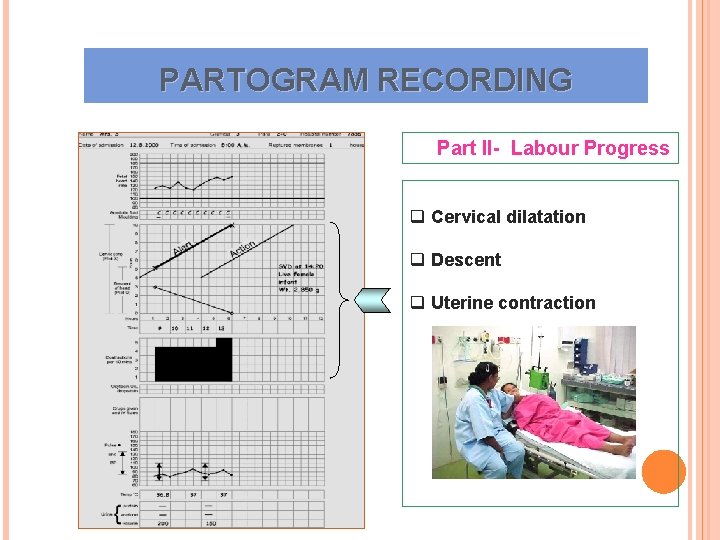 PARTOGRAM RECORDING Part II- Labour Progress q Cervical dilatation q Descent q Uterine contraction PARTOGRAM RECORDING Part II- Labour Progress q Cervical dilatation q Descent q Uterine contraction