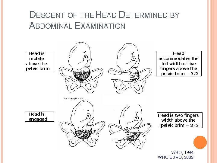 DESCENT OF THE HEAD DETERMINED BY ABDOMINAL EXAMINATION Head is mobile above the pelvic DESCENT OF THE HEAD DETERMINED BY ABDOMINAL EXAMINATION Head is mobile above the pelvic