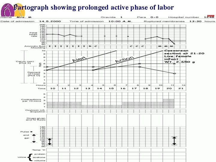 Effective Perinatal Care (EPC) Partograph showing prolonged active phase of labor 2 MO-30 Effective Perinatal Care (EPC) Partograph showing prolonged active phase of labor 2 MO-30