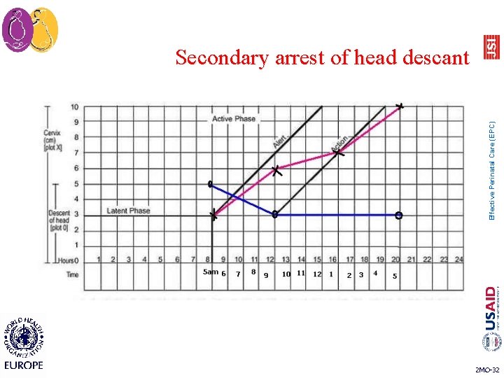 Effective Perinatal Care (EPC) Secondary arrest of head descant 2 MO-32 Effective Perinatal Care (EPC) Secondary arrest of head descant 2 MO-32