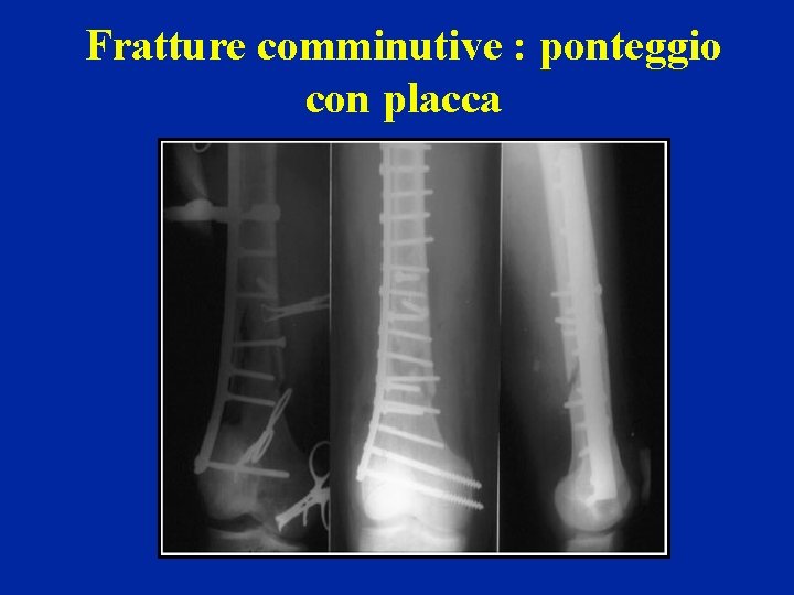 Fratture comminutive : ponteggio con placca 