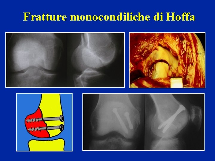 Fratture monocondiliche di Hoffa 