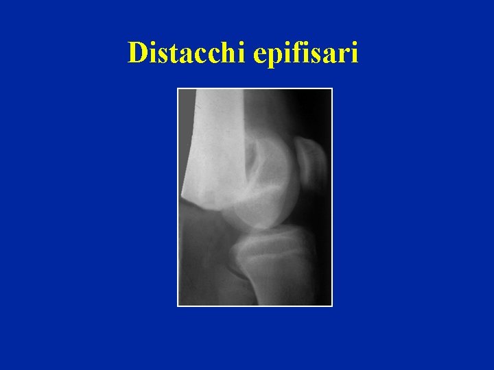 Distacchi epifisari 