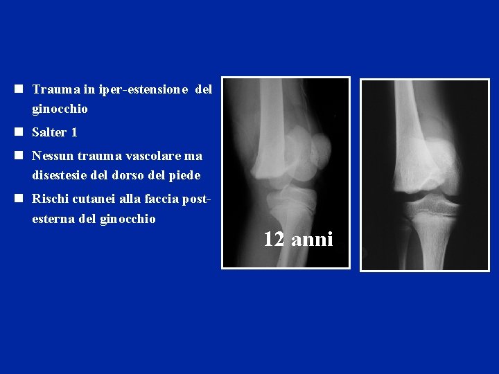 n Trauma in iper-estensione del ginocchio n Salter 1 n Nessun trauma vascolare ma