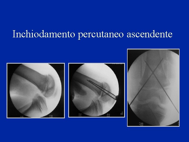 Inchiodamento percutaneo ascendente 