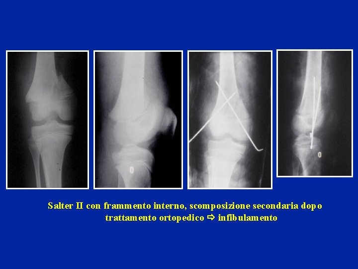 Salter II con frammento interno, scomposizione secondaria dopo trattamento ortopedico infibulamento 