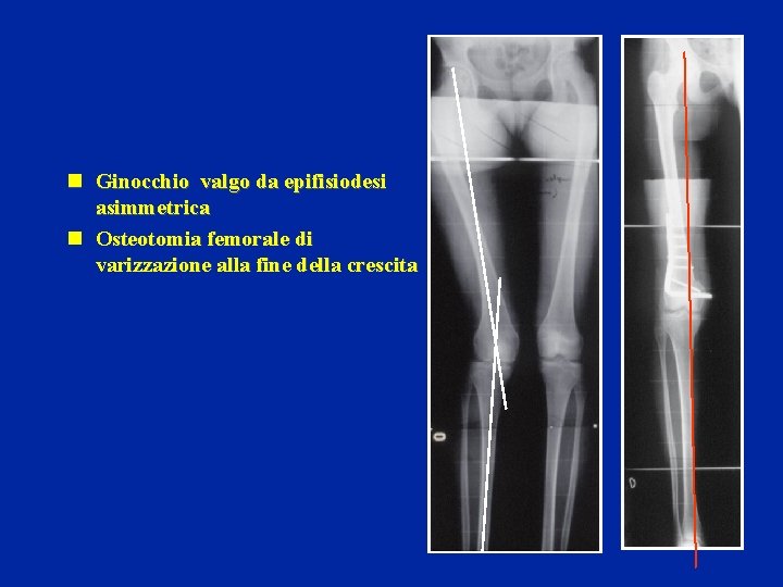 n Ginocchio valgo da epifisiodesi asimmetrica n Osteotomia femorale di varizzazione alla fine della