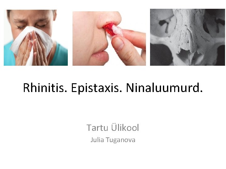 Rhinitis. Epistaxis. Ninaluumurd. Tartu Ülikool Julia Tuganova 