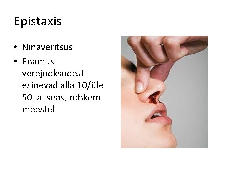 Epistaxis • Ninaveritsus • Enamus verejooksudest esinevad alla 10/üle 50. a. seas, rohkem meestel