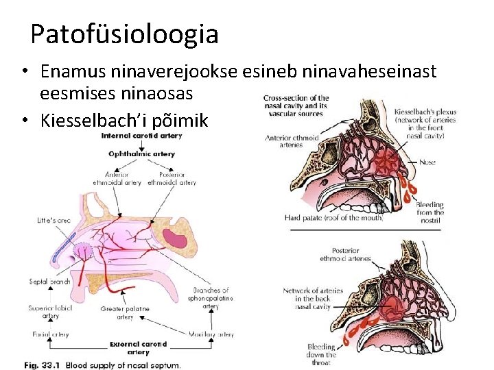 Patofüsioloogia • Enamus ninaverejookse esineb ninavaheseinast eesmises ninaosas • Kiesselbach’i põimik 