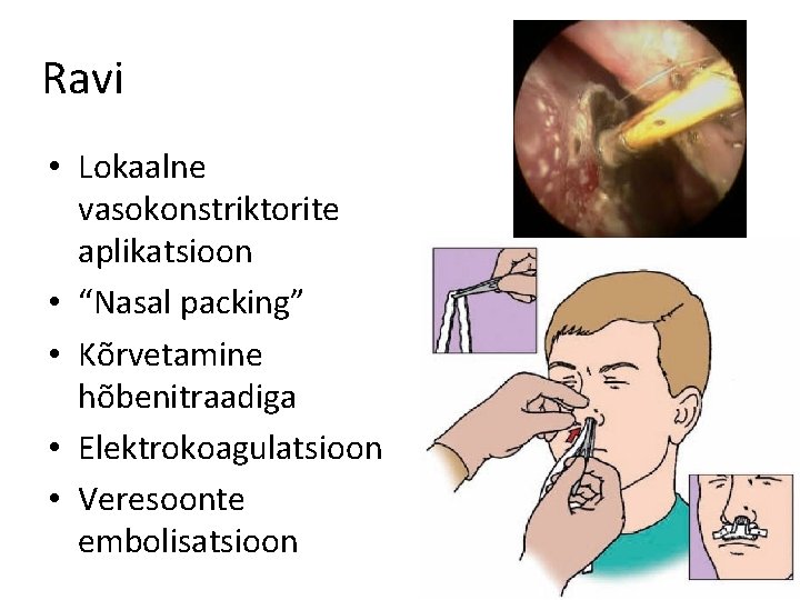 Ravi • Lokaalne vasokonstriktorite aplikatsioon • “Nasal packing” • Kõrvetamine hõbenitraadiga • Elektrokoagulatsioon •