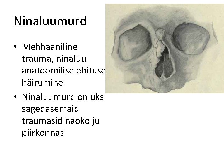 Ninaluumurd • Mehhaaniline trauma, ninaluu anatoomilise ehituse häirumine • Ninaluumurd on üks sagedasemaid traumasid