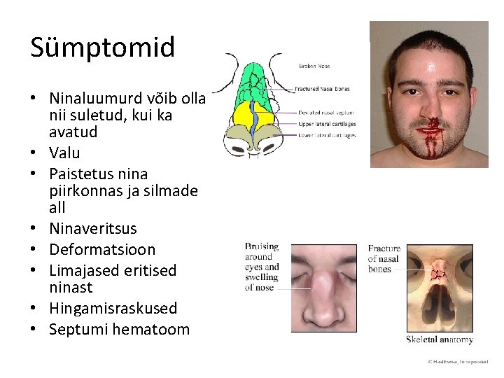 Sümptomid • Ninaluumurd võib olla nii suletud, kui ka avatud • Valu • Paistetus