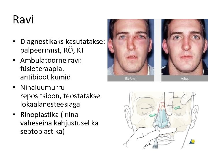 Ravi • Diagnostikaks kasutatakse: palpeerimist, RÖ, KT • Ambulatoorne ravi: füsioteraapia, antibiootikumid • Ninaluumurru