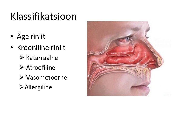 Klassifikatsioon • Äge riniit • Krooniline riniit Ø Katarraalne Ø Atroofiline Ø Vasomotoorne ØAllergiline