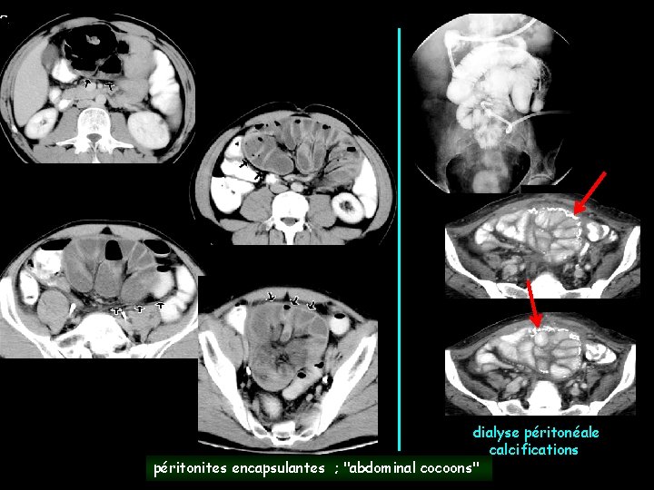 dialyse péritonéale calcifications péritonites encapsulantes ; "abdominal cocoons" 