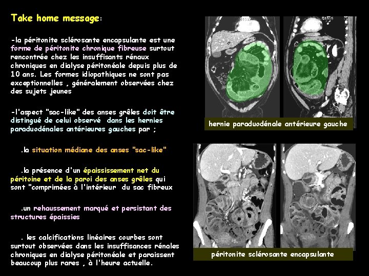 Take home message: -la péritonite sclérosante encapsulante est une forme de péritonite chronique fibreuse